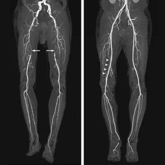CT Angiography Arteries Lower Limb
